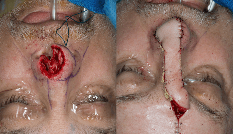 Mohs Reconstruction 01