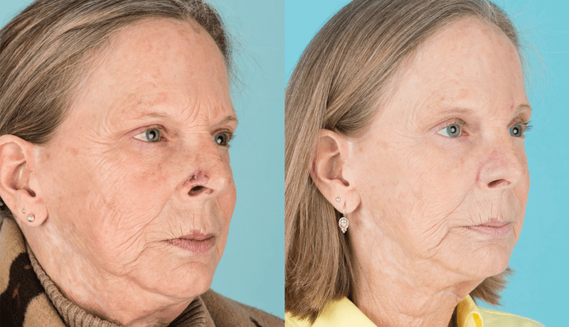 Mohs Reconstruction 02